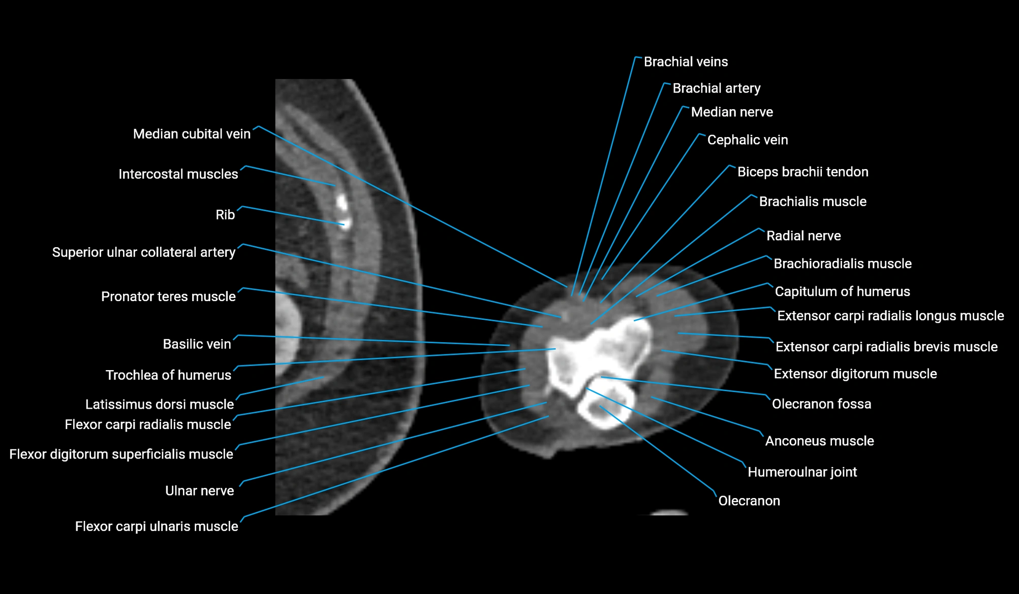 CT upper arm axial  cross sectional anatomy labelled radiology image -00392.webp